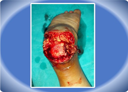 HEEL DEFECT